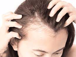 Chute de cheveux – Alopécie