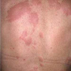 urticaire-dr-bentoumi-1-2-1